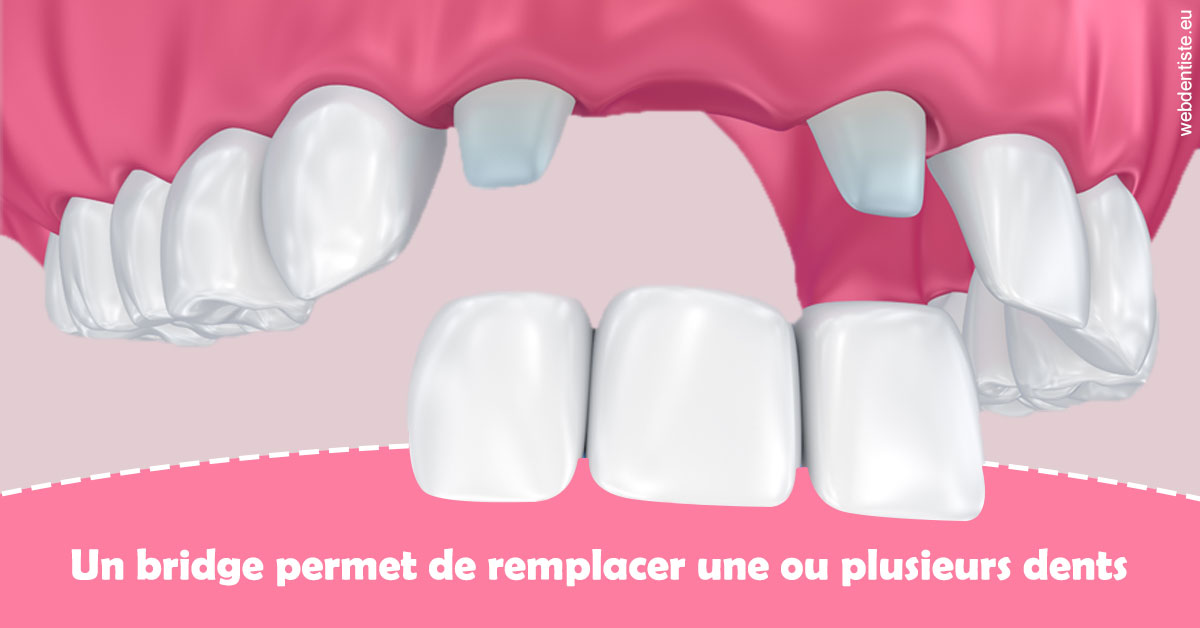 https://www.orthodontiste-demeure.com/Bridge remplacer dents 2