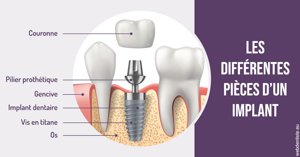 https://www.orthodontiste-demeure.com/Les différentes pièces d’un implant 2