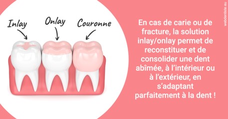 https://www.orthodontiste-demeure.com/L'INLAY ou l'ONLAY 2