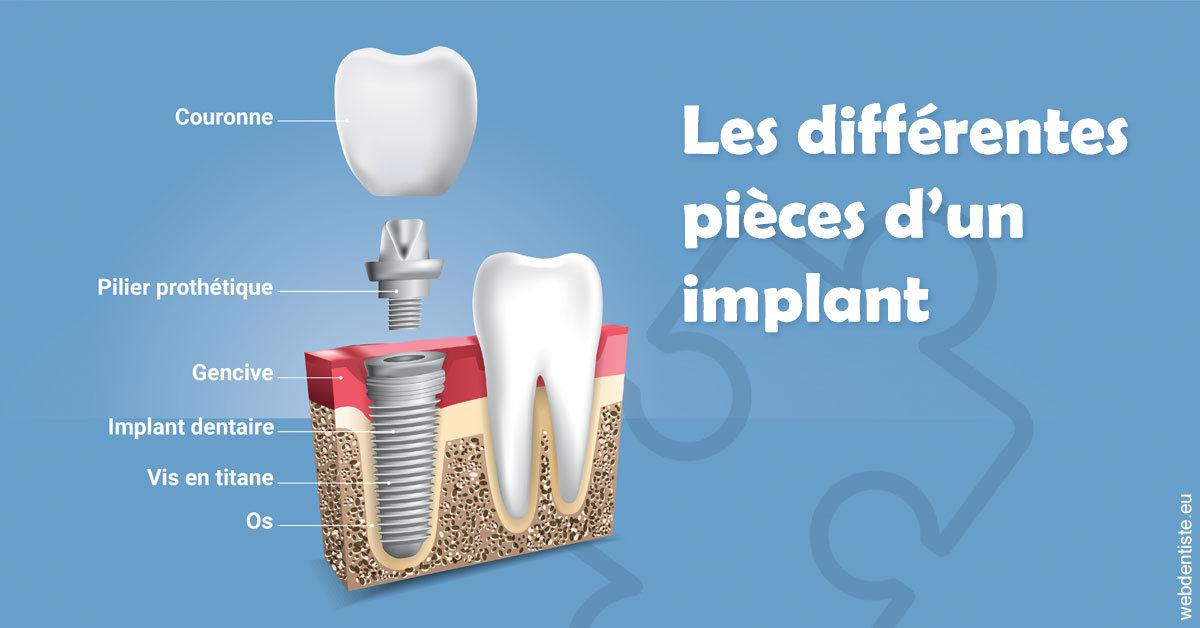 https://www.orthodontiste-demeure.com/Les différentes pièces d’un implant 1