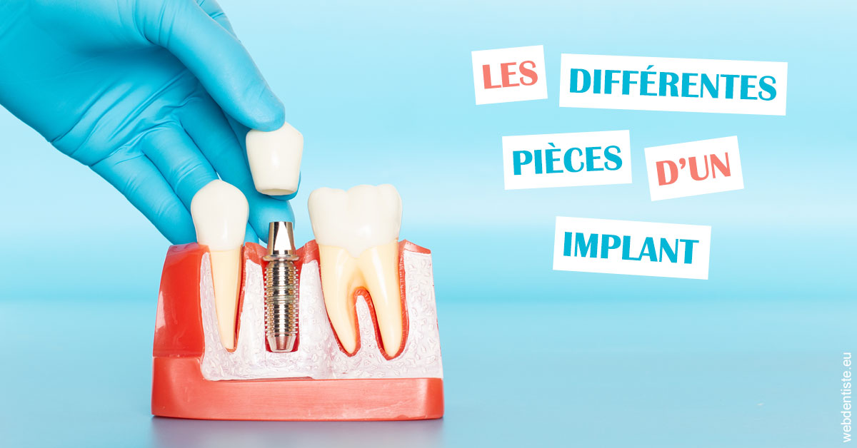 https://www.orthodontiste-demeure.com/Les différentes pièces d’un implant 2